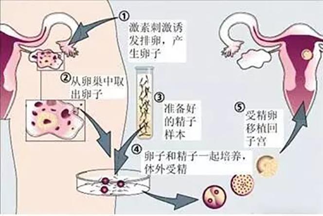 供卵试管过程_供卵试管：孕育生命的奇迹