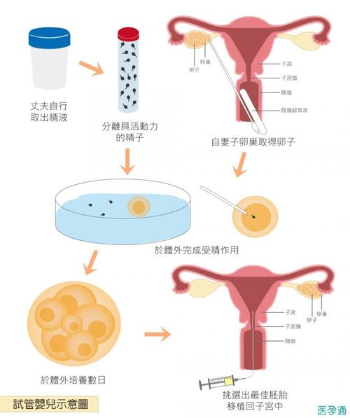供卵试管的步骤和流程_供卵试管:全面解读步骤和流程